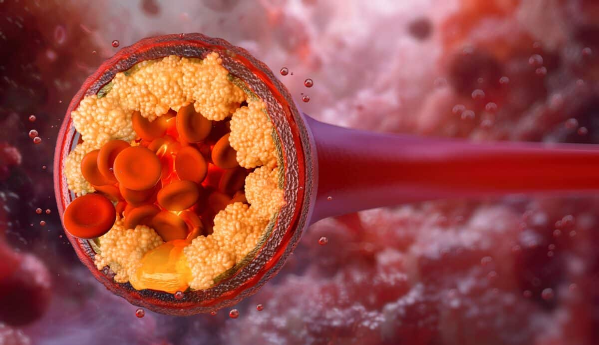 LDL cholesterol, atherosclerotic plaque in blood vessels.