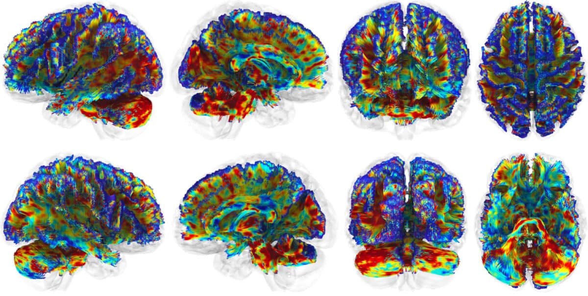 Image showing the average change in inflammation from the start to the end of the football season within each region of the brain, for football players on the placebo treatment. Red corresponds to the greatest increase in inflammation.
