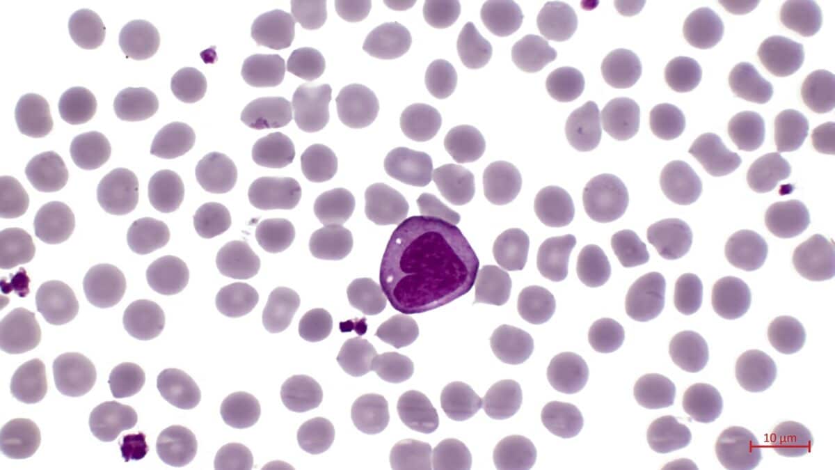 monocyte, white blood cell, inflammation