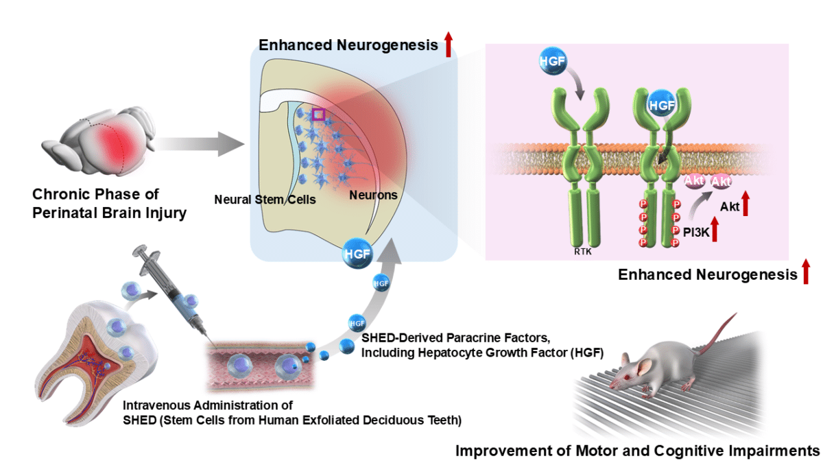 baby stem cells cerebral palsy