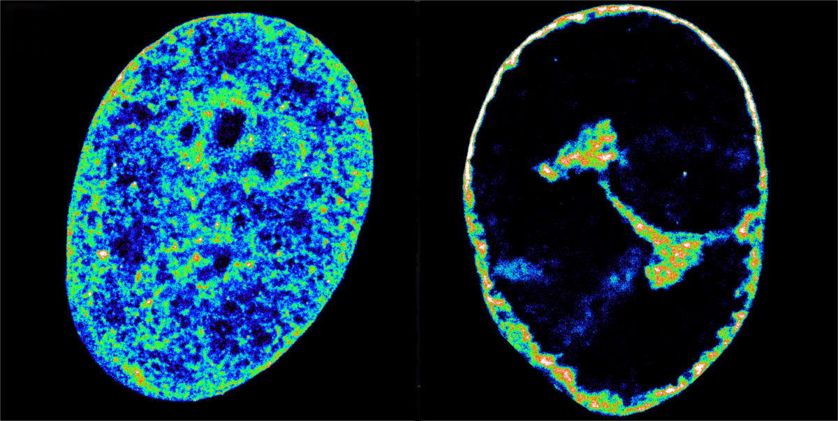 Human DNA in its natural state inside cells (left) compared to eight hours after being infected with HSV-1 (right).