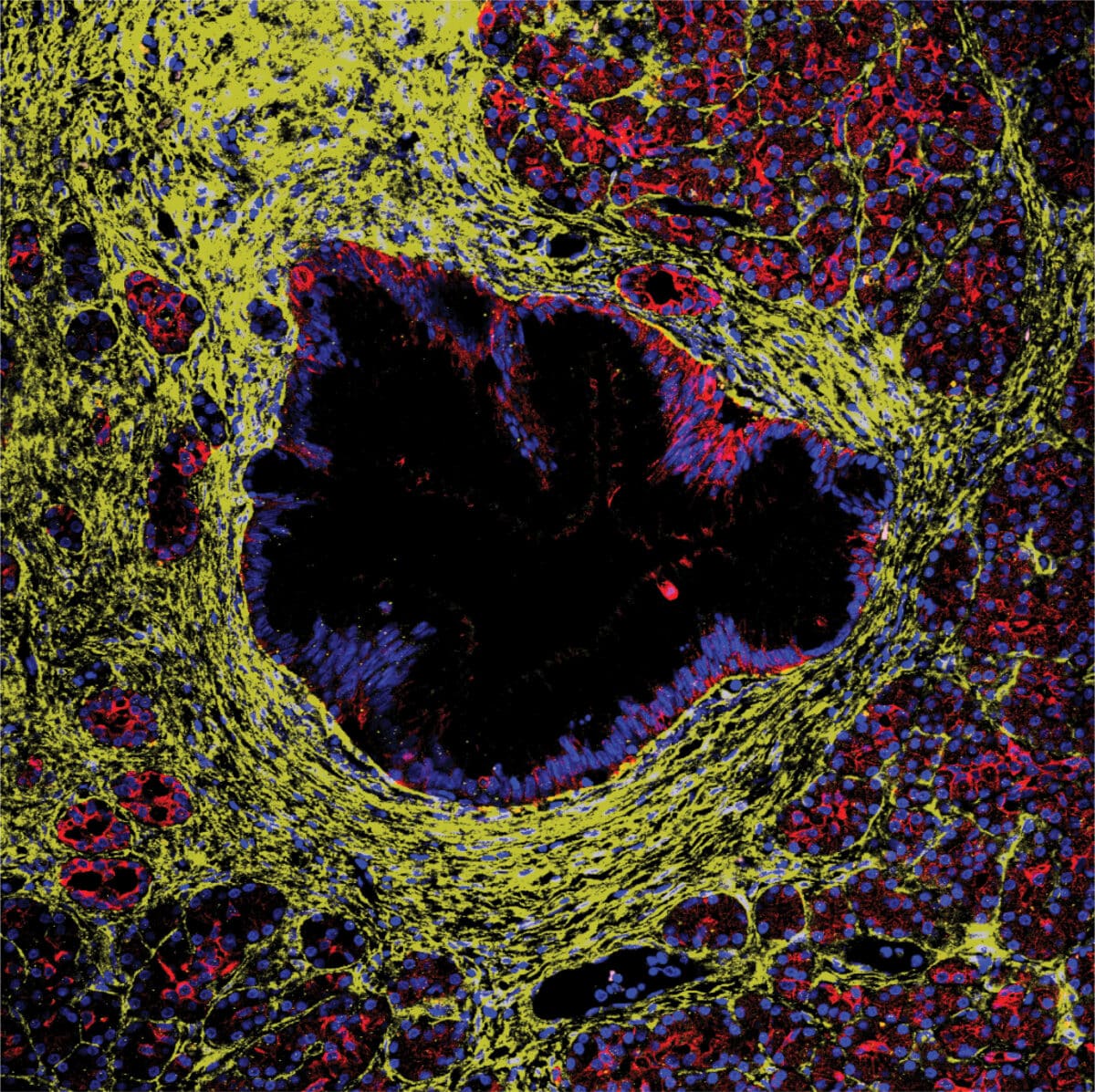 PanINmicroenvironment