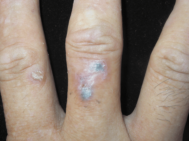 Skin Cancer Found On Finger A Rare Site For Basal Cell Carcinoma skin-cancer-found-on-finger-a-rare-site-for-basal-cell-carcinoma