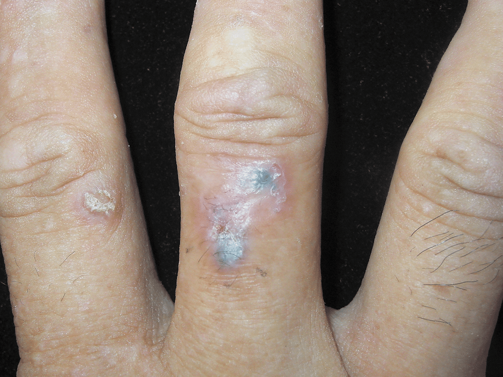 finger cancer