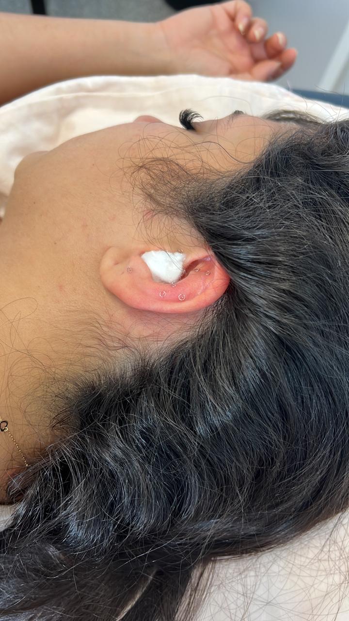 Auriculotherapy for a migraine patient showing the semi-permanent needles in place.