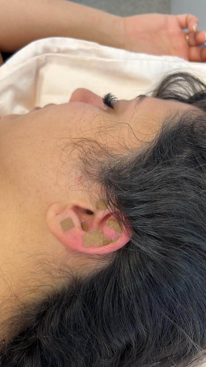 Mustard seeds held in place with high-adhesion medical tape for a migraine patient receiving auriculotherapy.