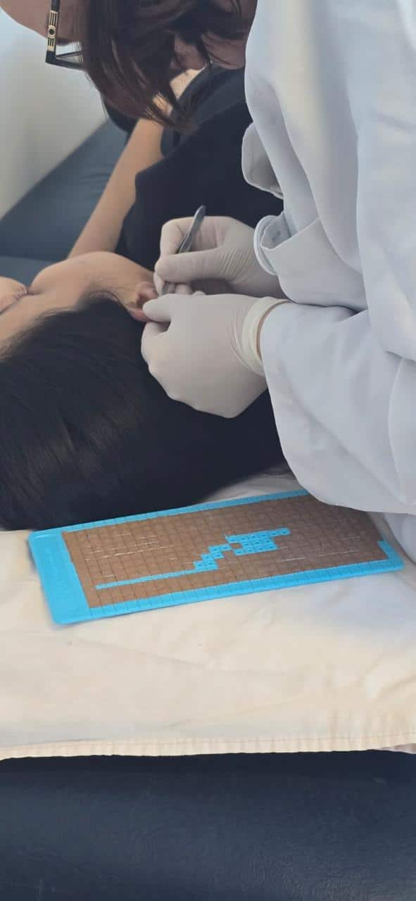 Auriculotherapy for a migraine patient.
