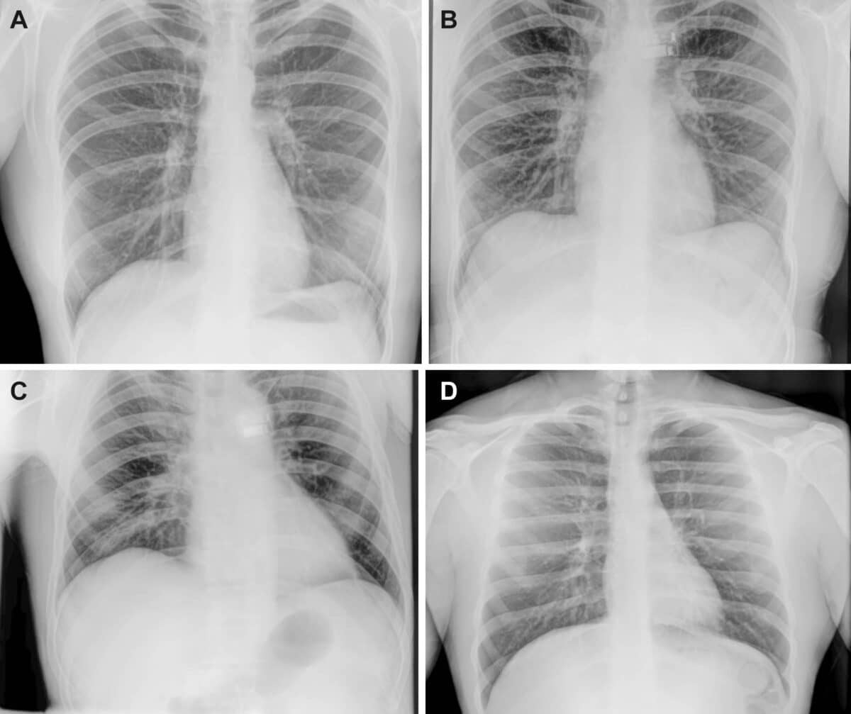 Representative preflight, in-flight, and post-flight chest radiographs.