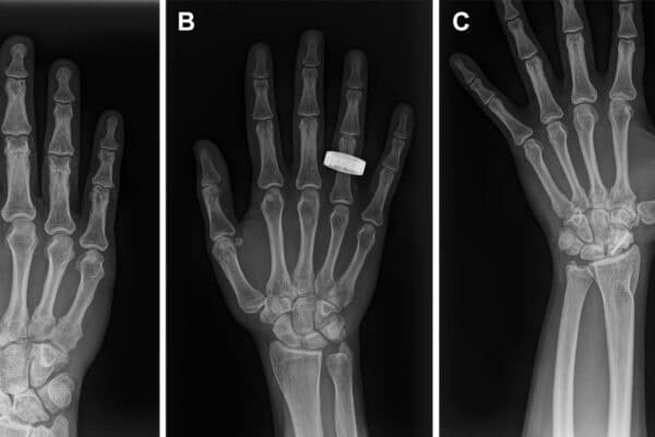 Representative preflight, in-flight, and post-flight hand radiographs.
