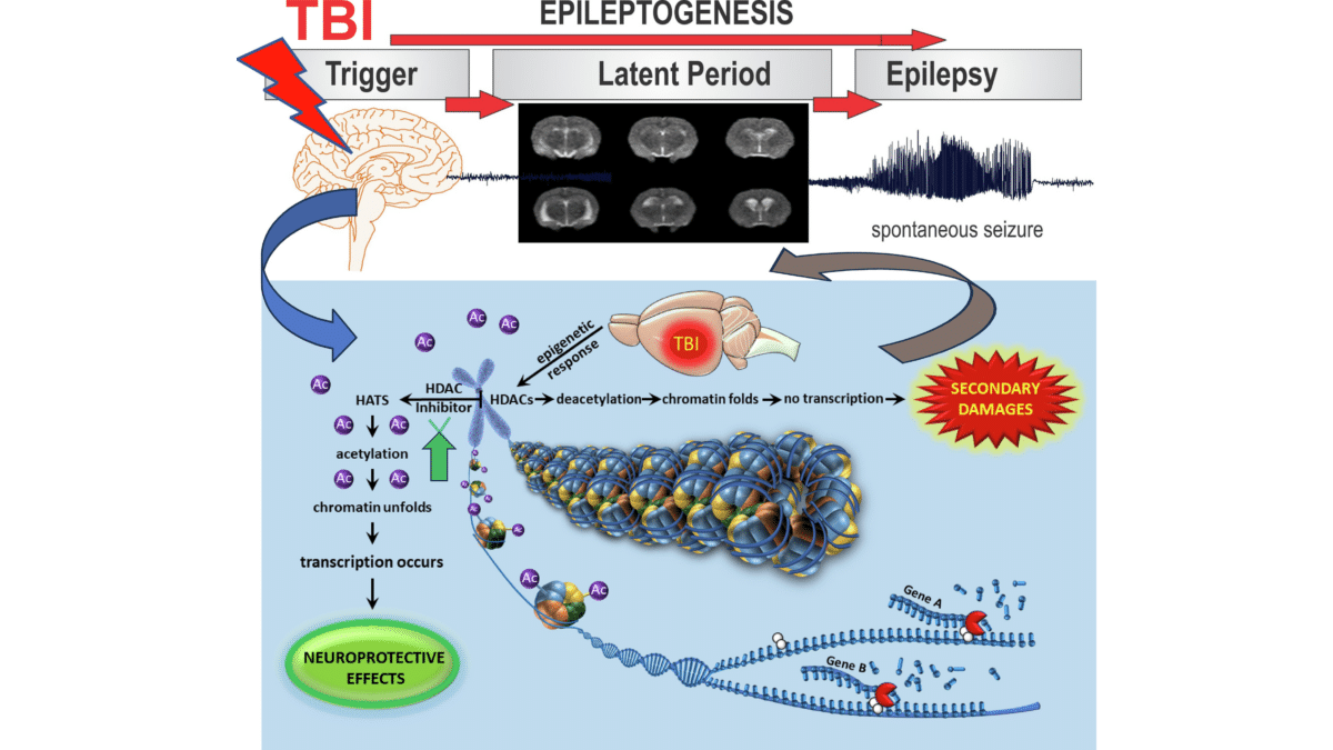 epileptogensis