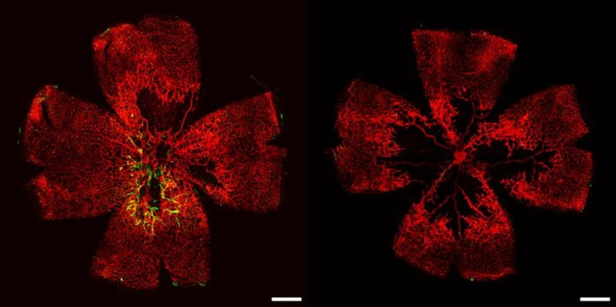 This red image depicts a mouse’s retina suffering from conditions similar to diabetic retinopathy both before (right) and after (left) being treated with human lab-grown retinal endothelial cells. The green in the left image shows the human lab-grown retinal endothelial cells integrating into the damaged mouse retina, demonstrating their potential use to treat early stages of the disease.