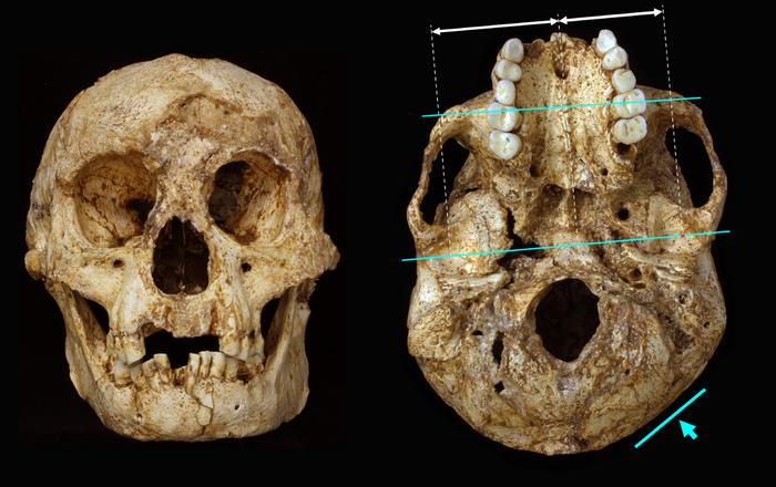 image of Front and base view of LB1, the type specimen of H. floresiensis. The arrows show the sites and directions of the main forces presumed to have caused cranial deformation.