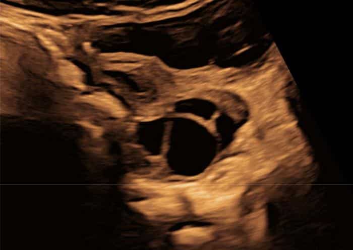 ultrasound of infant ovary
