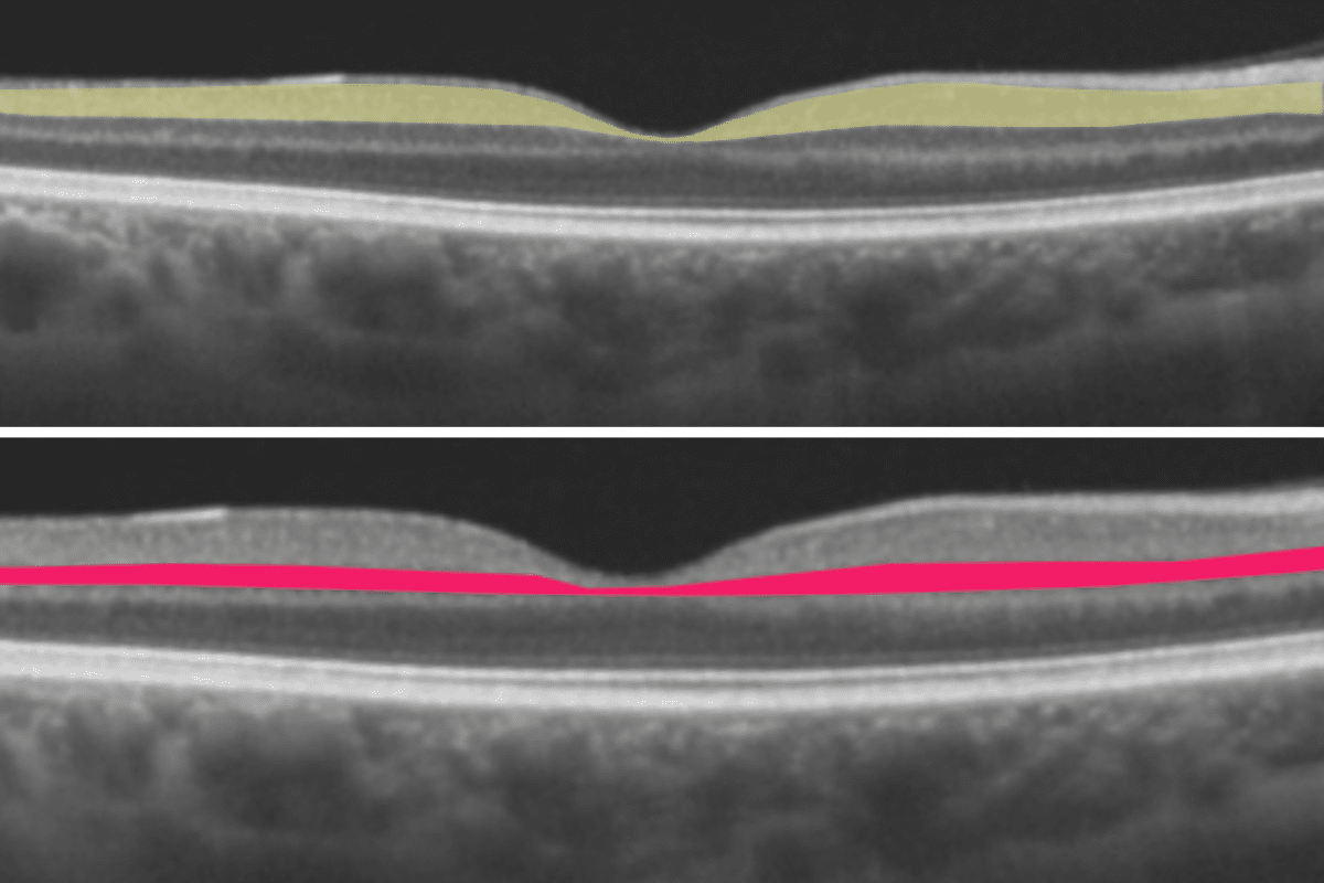 thinning retina