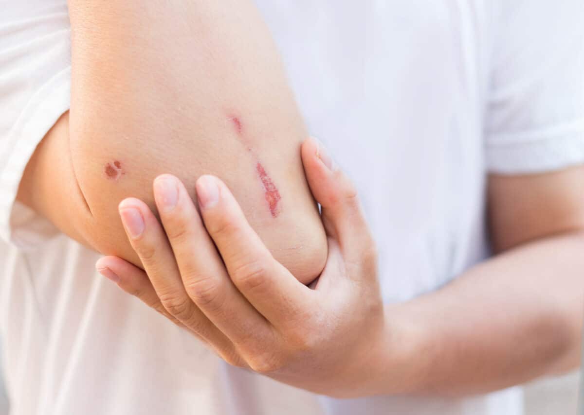 Man show lesion or wound on his arm after accident