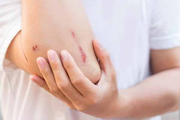 Man show lesion or wound on his arm after accident