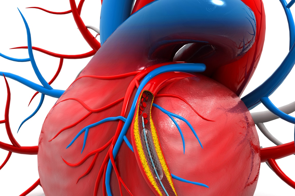 Stent angioplasty procedure with placing a balloon