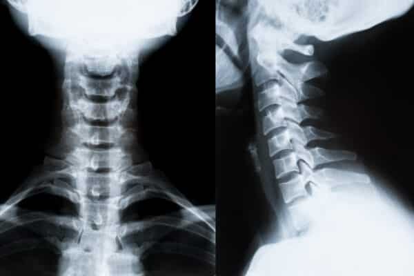 X-ray image of neck and spine