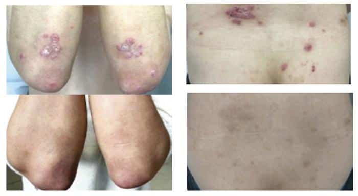 before and after picture of a patients forearms and back with psoriaris inflammation